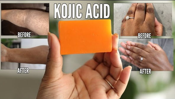 How to use kojic acid soap you should know